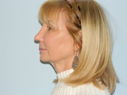 Rhinoplasty Before & After Patient #2942
