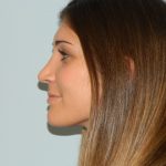 Rhinoplasty Before & After Patient #2984