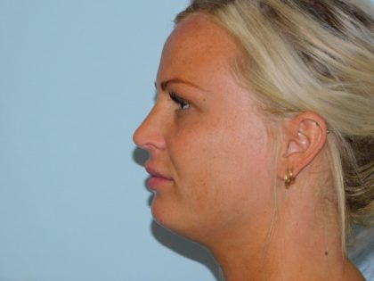 Rhinoplasty Before & After Patient #2985