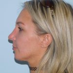 Rhinoplasty Before & After Patient #2986