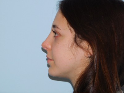 Rhinoplasty Before & After Patient #3036