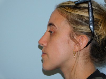 Rhinoplasty Before & After Patient #3037