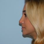 Rhinoplasty Before & After Patient #2989