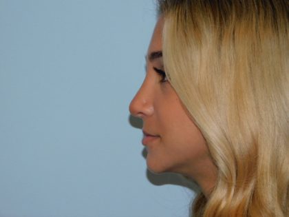 Rhinoplasty Before & After Patient #2989