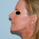 Traditional Facelift Before & After Patient #1719