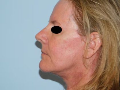 Traditional Facelift Before & After Patient #1719