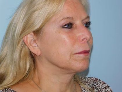 Traditional Facelift Before & After Patient #1749