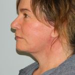 Traditional Facelift Before & After Patient #1751