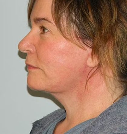Traditional Facelift Before & After Patient #1751