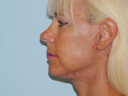 Traditional Facelift Before & After Patient #1810