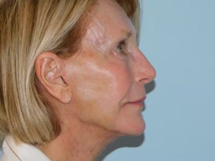 Traditional Facelift Before & After Patient #1813