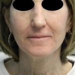 Fraxel Laser Resurfacing Before & After Patient #1492