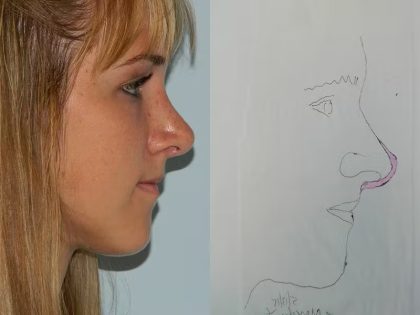 Revision Rhinoplasty Before & After Patient #1596