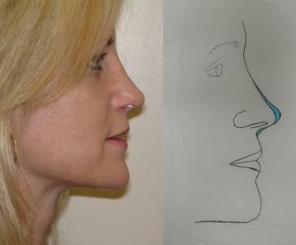Revision Rhinoplasty Before & After Patient #1600