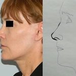Revision Rhinoplasty Before & After Patient #1516