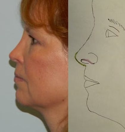 Revision Rhinoplasty Before & After Patient #1518