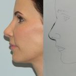 Revision Rhinoplasty Before & After Patient #1545