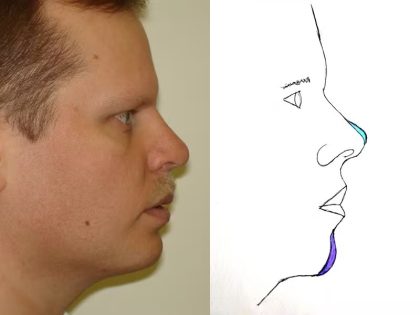 Chin Augmentation Before & After Patient #1118