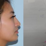 Chin Augmentation Before & After Patient #1120