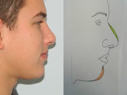 Chin Augmentation Before & After Patient #1195