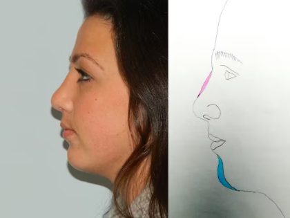 Chin Augmentation Before & After Patient #1218