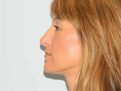 Chin Reduction Before & After Patient #1254
