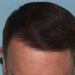 Hair Transplant Smartgraft Before & After Patient #1387