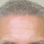 Hair Transplant Smartgraft Before & After Patient #1388