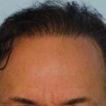 Hair Transplant Smartgraft Before & After Patient #1390