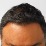 Hair Transplant Smartgraft Before & After Patient #1402