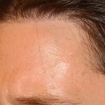 Hair Transplant Smartgraft Before & After Patient #1351