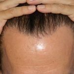 Hair Transplant Smartgraft Before & After Patient #1363