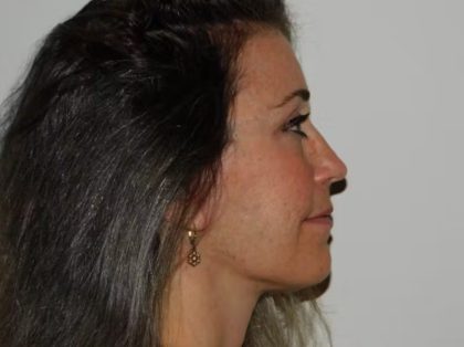 Neck Submental Liposuction Before & After Patient #955