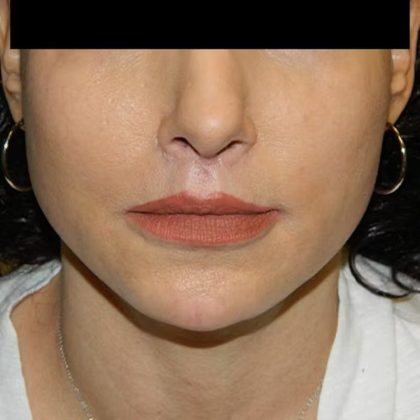Lip Lift Before & After Patient #1294