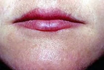Lip Lift Before & After Patient #1273