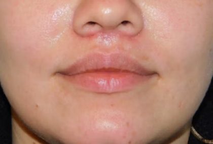 Lip Lift Before & After Patient #1282