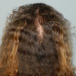 PRP Injections for Hairloss Before & After Patient #1474