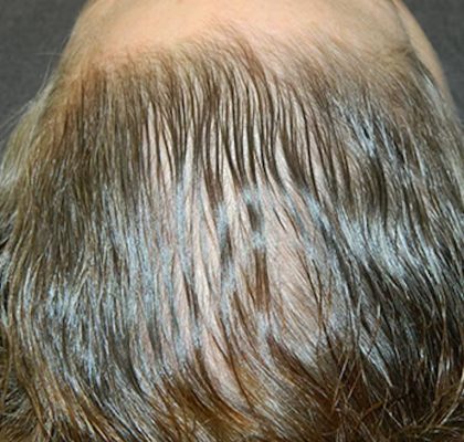 PRP Injections for Hairloss Before & After Patient #1476
