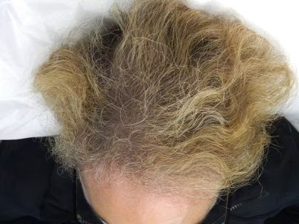 PRP Injections for Hairloss Before & After Patient #1477