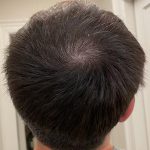 PRP Injections for Hairloss Before & After Patient #1478