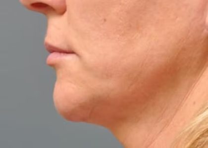 Ultherapy Before & After Patient #1439