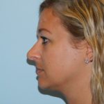 Rhinoplasty Before & After Patient #3041