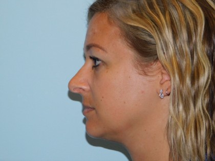 Rhinoplasty Before & After Patient #3041