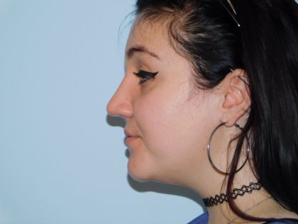 Rhinoplasty Before & After Patient #3051