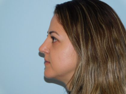 Rhinoplasty Before & After Patient #3055