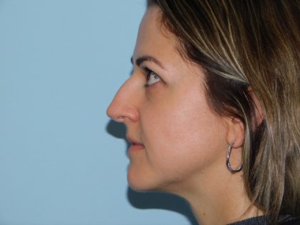 Rhinoplasty Before & After Patient #3055