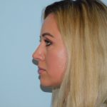 Rhinoplasty Before & After Patient #3056