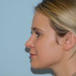 Rhinoplasty Before & After Patient #3060