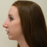 Rhinoplasty Before & After Patient #3061
