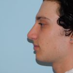 Rhinoplasty Before & After Patient #3064